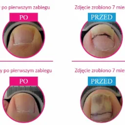 usuwanie grzybicy paznokci laserem