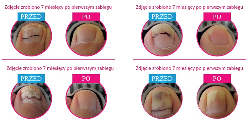 usuwanie grzybicy paznokci laserem