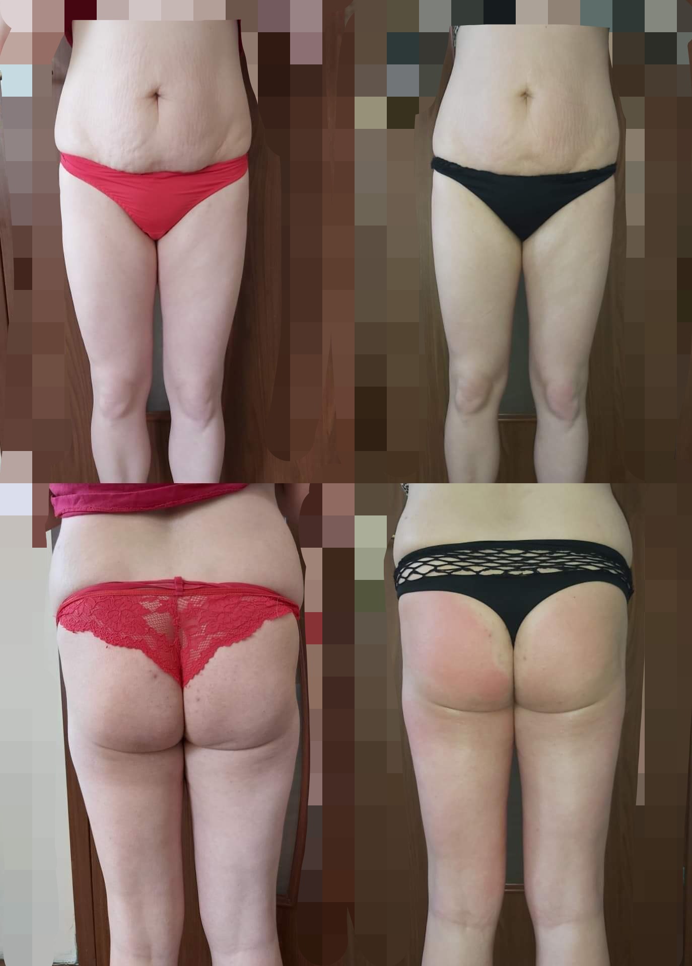 Kolaż przedstawiający sylwetkę kobiety przed i po zabiegu dermomasażu. Górny rząd ukazuje przód sylwetki w czerwonej i czarnej bieliźnie, dolny rząd ukazuje tył sylwetki w czerwonej koronkowej...