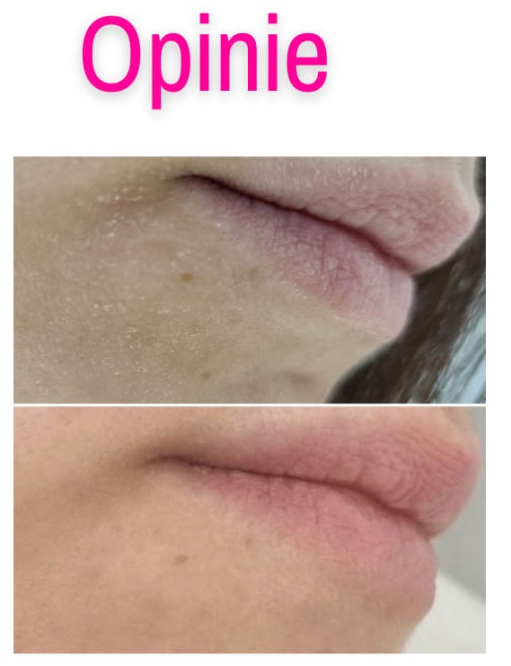 Porównanie ust przed i po zabiegu: górne usta z widocznymi suchymi skórkami, dolne usta po zabiegu, nawilżone i gładkie.