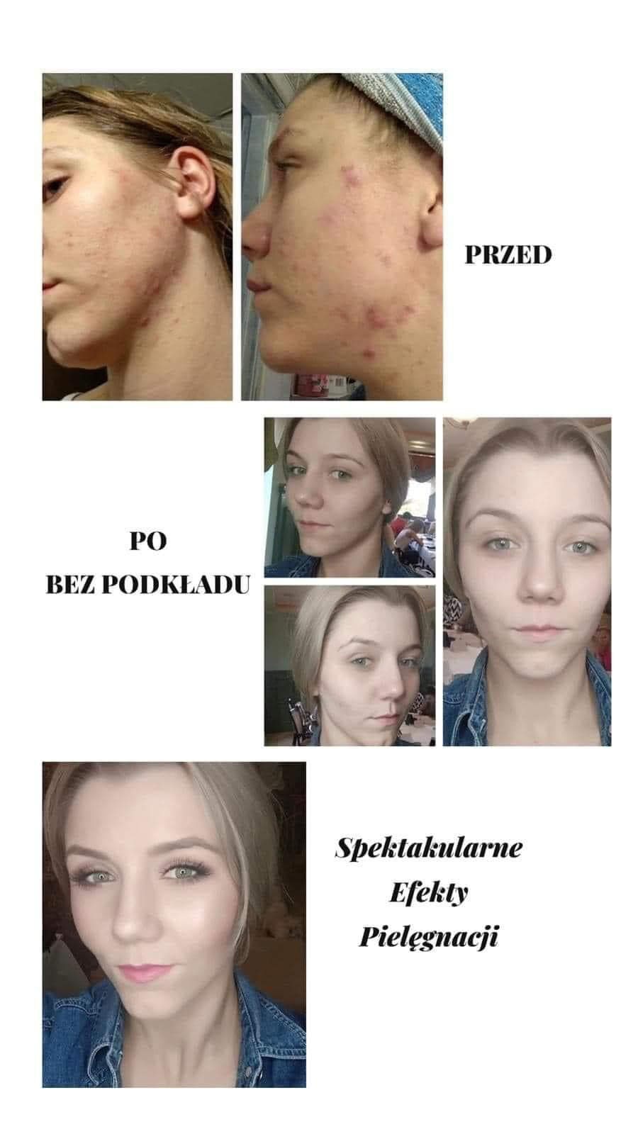 Porównanie stanu skóry twarzy przed i po zabiegu pielęgnacyjnym, bez użycia podkładu, widoczne zmniejszenie niedoskonałości.