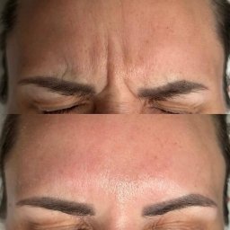 Medycyna Estetyczna - Dominika Jezierska - Zdjęcie 'przed i po' zabiegu redukcji zmarszczek na czole, ukazujące wygładzoną skórę i zrelaksowany wygląd.