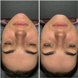 Medycyna Estetyczna - Dominika Jezierska - Zbliżenie na twarz kobiety przed i po zabiegu kosmetycznym. Widoczne zaczerwienienia i zmiany skórne przed, oraz poprawa wyglądu cery po zabiegu.