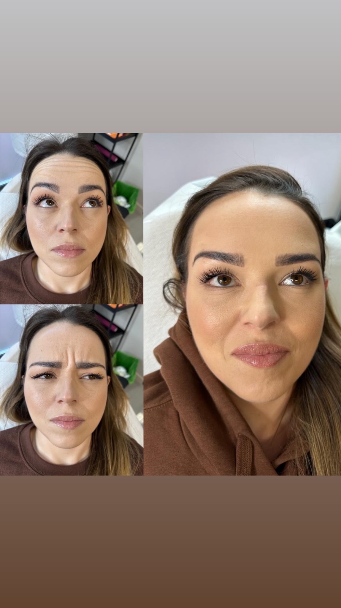 Kobieta przed i po zabiegu na zmarszczki mimiczne czoła. Widoczne wygładzenie skóry, uniesienie brwi i poprawa napięcia. Zdjęcie wykonane w salonie kosmetycznym.