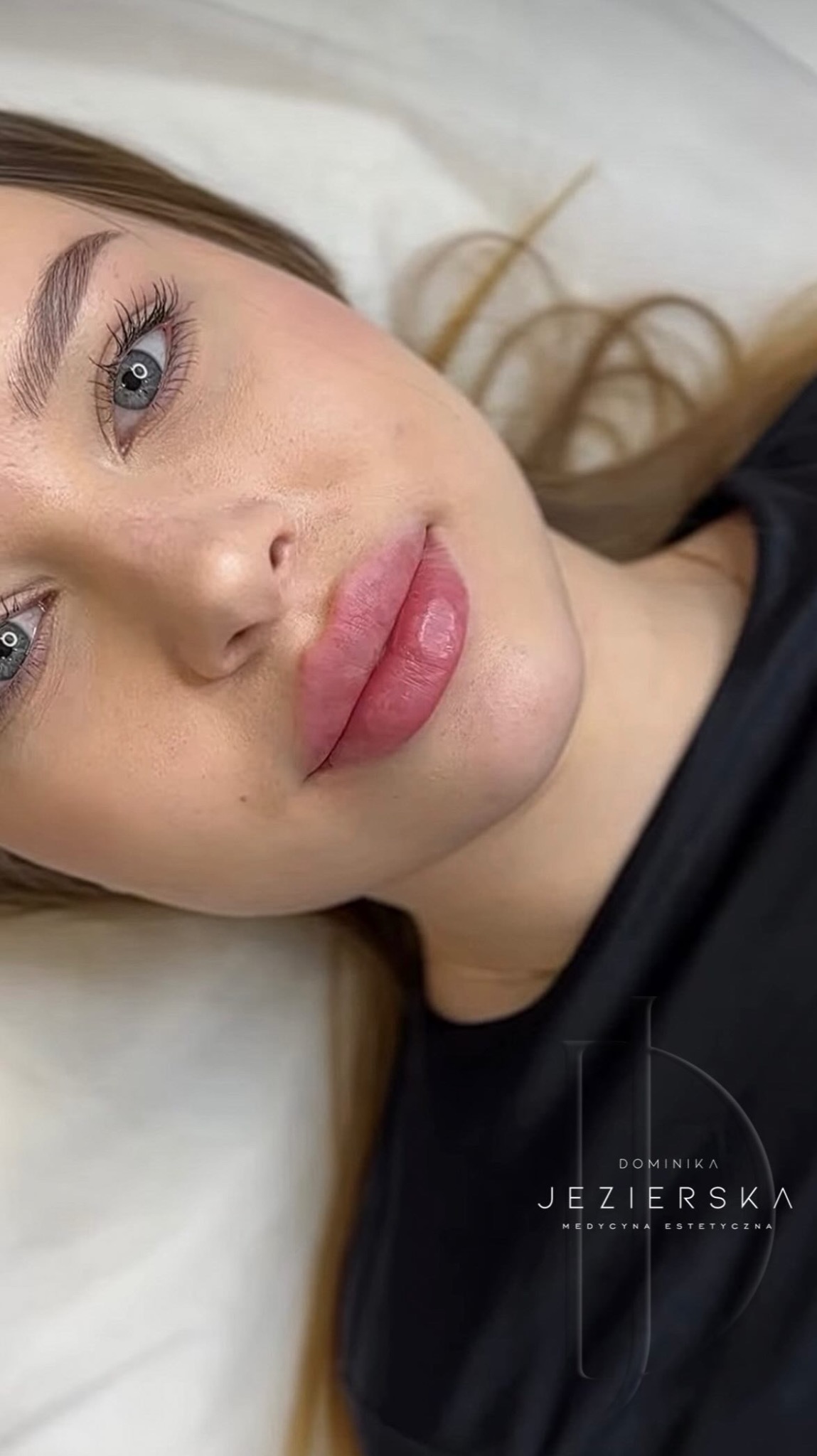 Powiększone, błyszczące usta kobiety po zabiegu, widoczne delikatne podkreślenie konturu. Ujęcie z bliska, jasna karnacja, widoczne długie rzęsy.