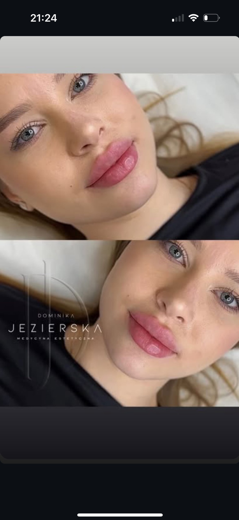 Ujęcie twarzy kobiety po zabiegu powiększania ust, z widoczną pełnią i symetrią warg. Na dole logo gabinetu medycyny estetycznej.