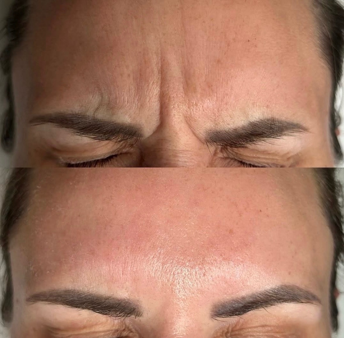 Zdjęcie 'przed i po' zabiegu redukcji zmarszczek na czole, ukazujące wygładzoną skórę i zrelaksowany wygląd.