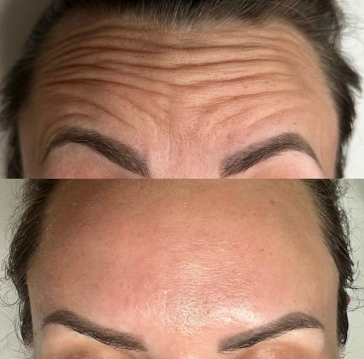 Zdjęcie 'przed i po' redukcji zmarszczek na czole. Górna część ukazuje głębokie zmarszczki, dolna gładką skórę, podkreślając efekt zabiegu.