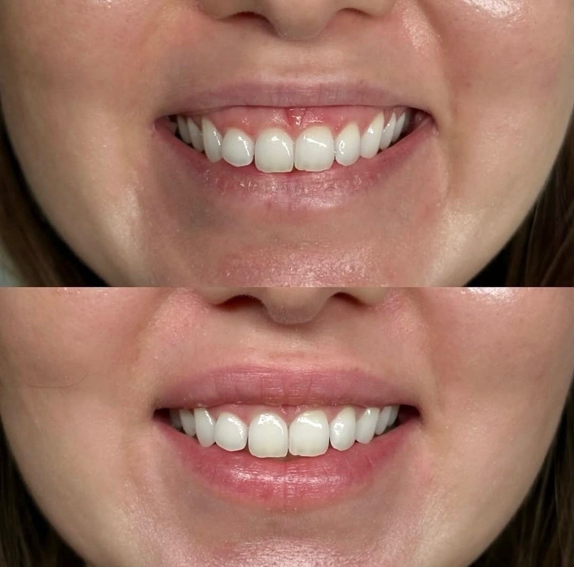 Zbliżenie na uśmiech kobiety przed i po zabiegu wybielania zębów. Widoczne różnice w odcieniu i blasku zębów. Górna część 'przed', dolna 'po'.