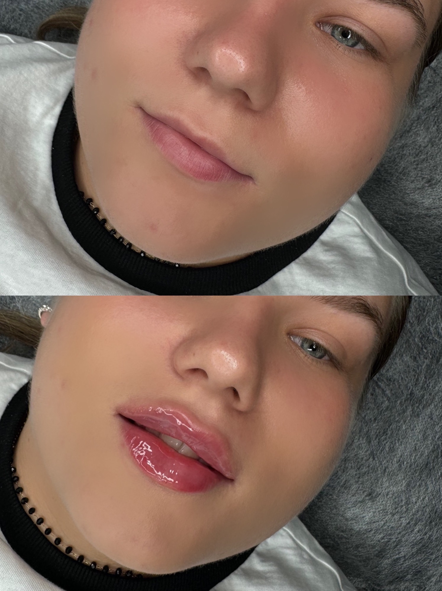 Zbliżenie na twarz kobiety przed i po zabiegu powiększania ust. Usta przed zabiegiem są naturalne, a po zabiegu pełne i błyszczące. Widoczna poprawa wyglądu.