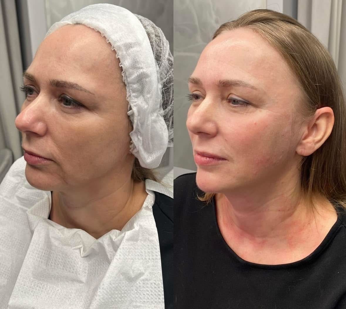 Kobieta przed i po zabiegu liftingu twarzy. Po prawej stronie widoczna poprawa napięcia skóry i redukcja zmarszczek. Zdjęcie profilowe, zbliżenie.