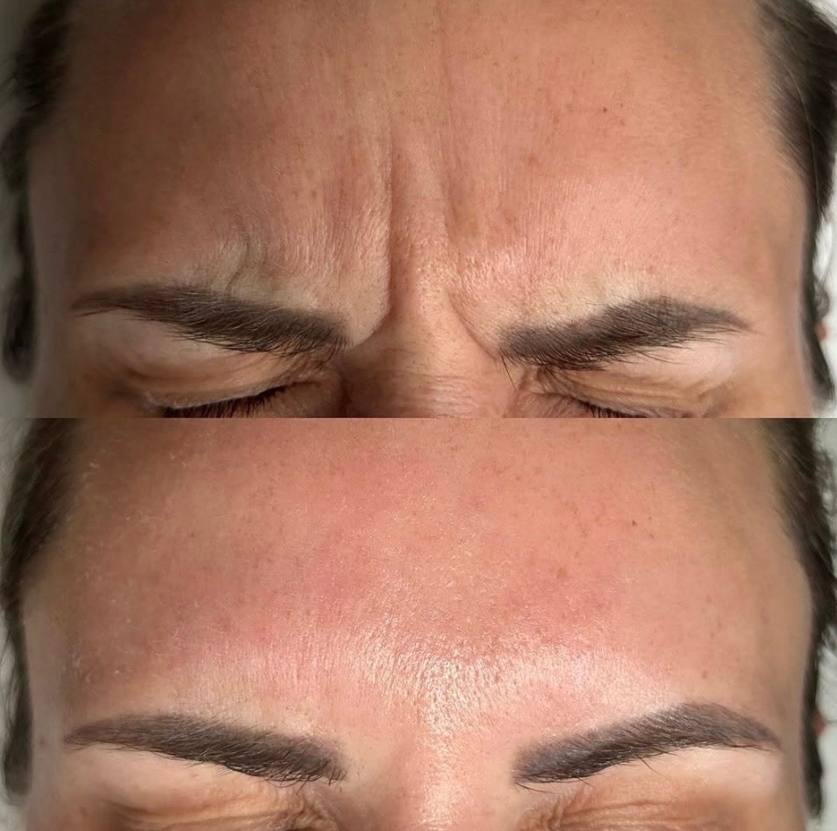 Zdjęcie 'przed i po' redukcji zmarszczek mimicznych na czole, ukazujące wygładzoną skórę po zabiegu. Widoczne brwi i zamknięte oczy modelki.