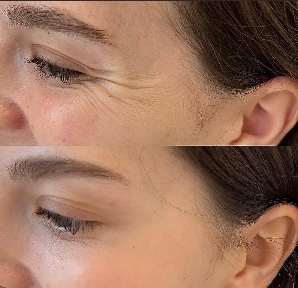 Zdjęcie 'przed i po' redukcji zmarszczek mimicznych wokół oka, ukazujące różnicę w gładkości skóry i redukcji drobnych linii. Skóra jasna, oświetlenie studyjne.