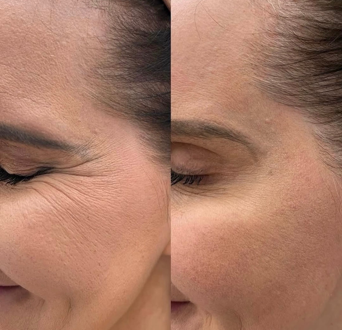 Efekt zabiegu redukcji zmarszczek: porównanie stanu skóry twarzy przed i po, widoczne wygładzenie okolic oka i czoła. Skóra o naturalnym kolorycie.