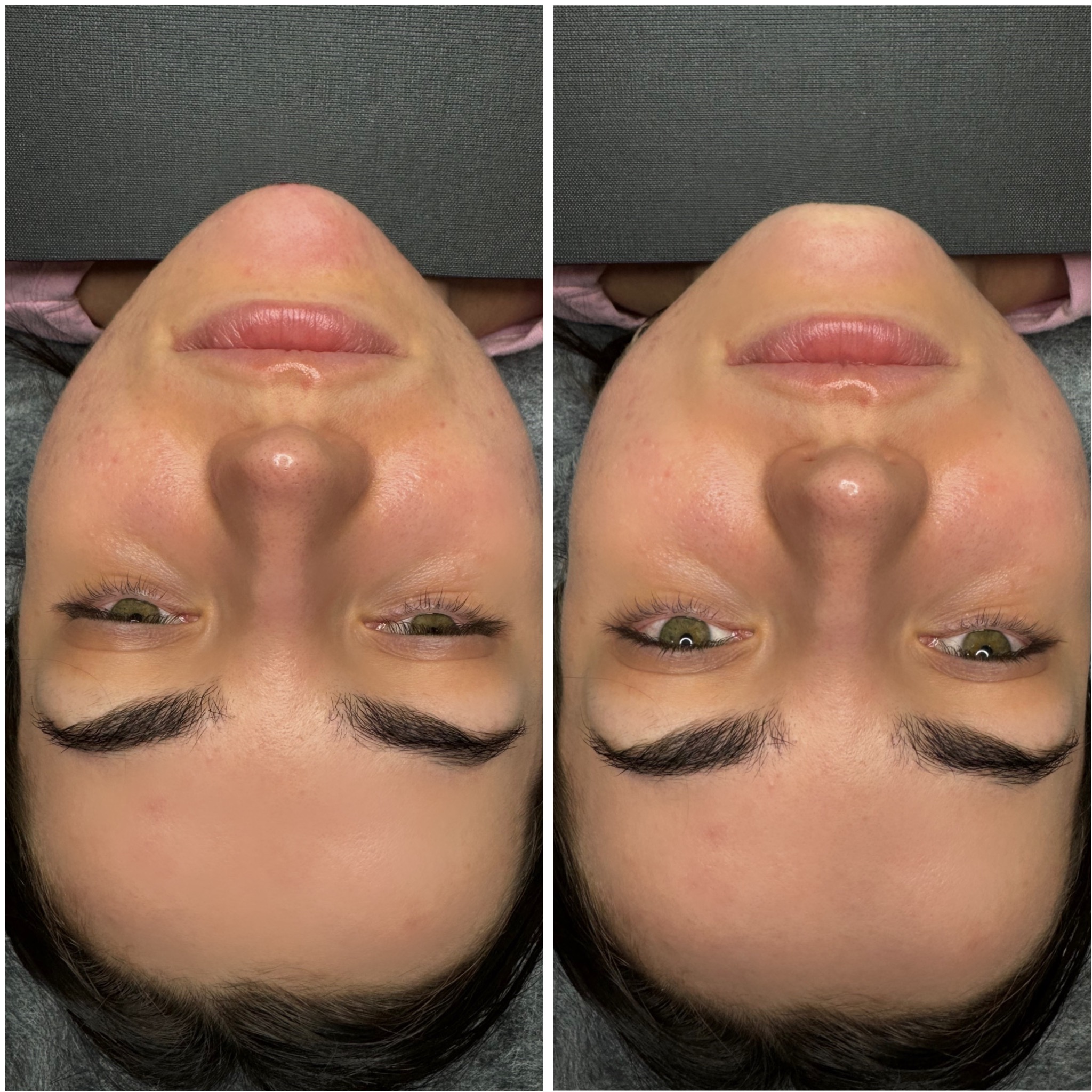 Zbliżenie na twarz kobiety przed i po zabiegu kosmetycznym. Widoczne zaczerwienienia i zmiany skórne przed, oraz poprawa wyglądu cery po zabiegu.