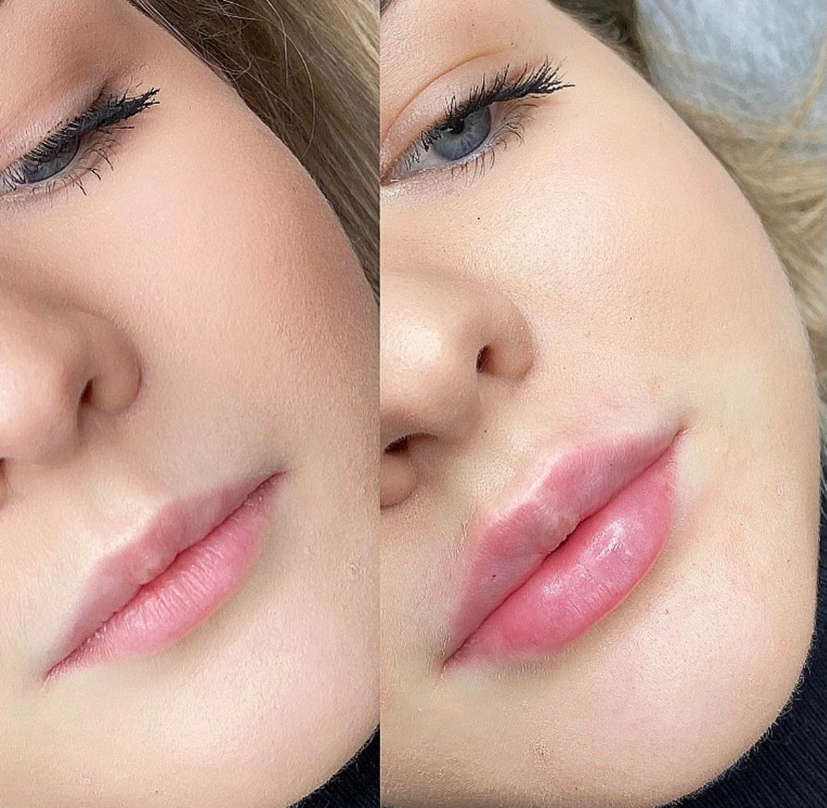 Zbliżenie na kobiece usta przed i po zabiegu powiększania, widoczna różnica w objętości i kształcie, delikatne zaczerwienienie wokół ust po prawej stronie.