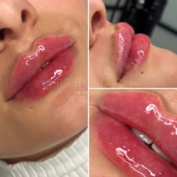 Lips by Nurse - Redukcja Cellulitu Racibórz