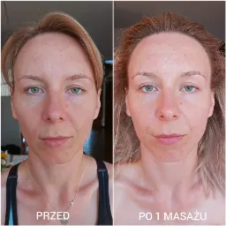 Zdjęcie typu 'przed i po' prezentujące twarz kobiety przed i po jednym masażu Kobido, z widoczną poprawą kolorytu i redukcją zaczerwienień.