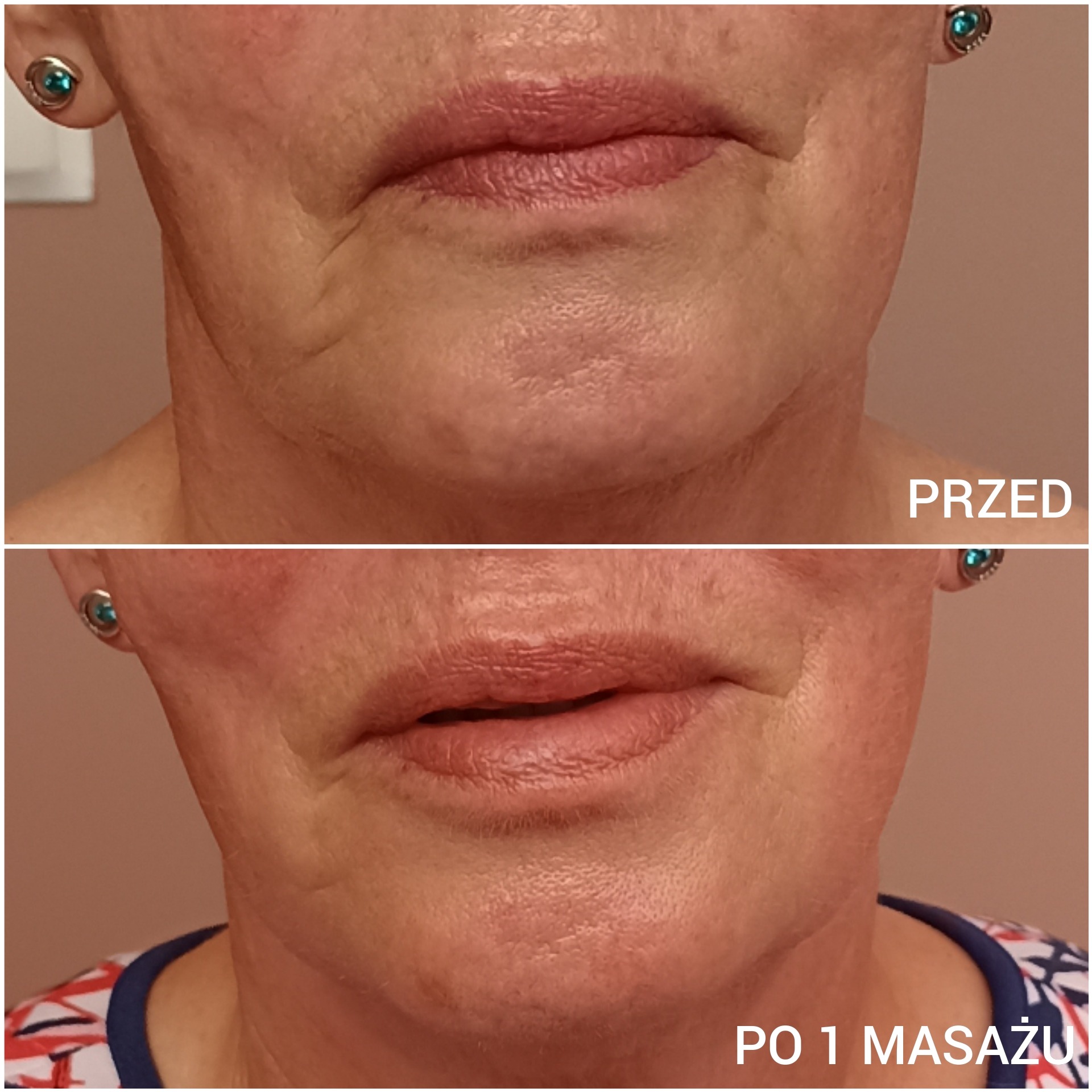 Porównanie twarzy przed i po jednym masażu kobido, widoczne zmniejszenie zmarszczek i poprawa napięcia skóry, ujęcie na szyję i usta.