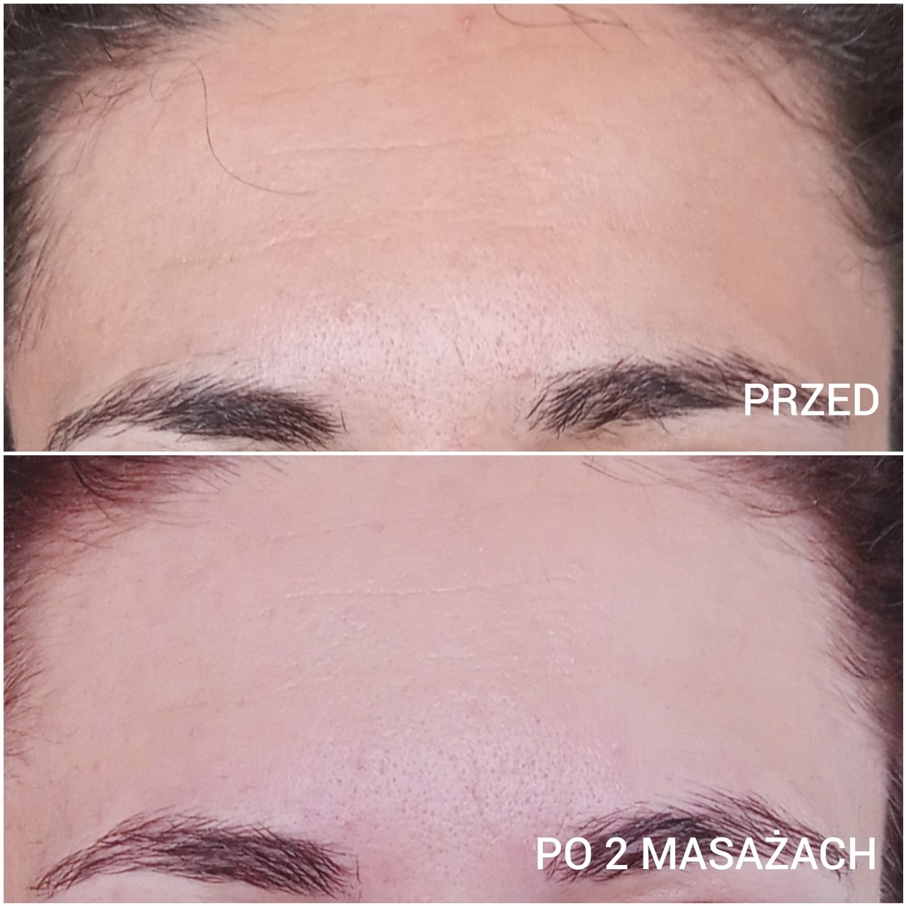 Porównanie skóry czoła przed i po dwóch masażach Kobido, ukazujące redukcję zmarszczek mimicznych.