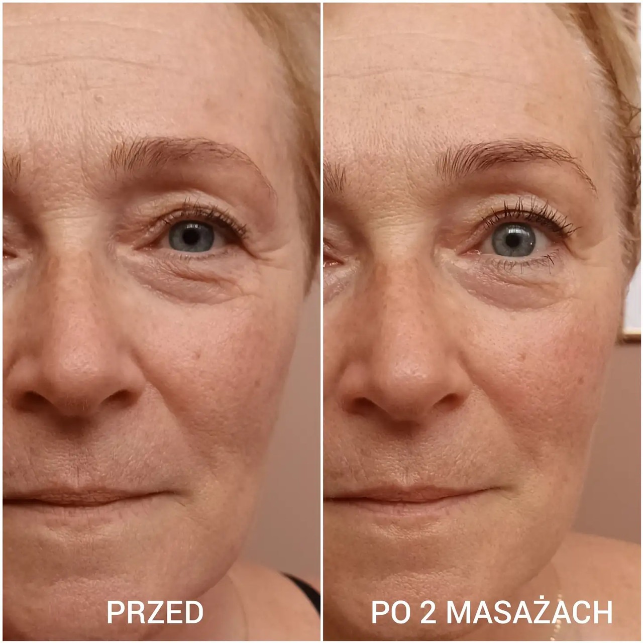 Zdjęcie porównawcze twarzy kobiety przed i po dwóch masażach, ukazujące redukcję zmarszczek i poprawę napięcia skóry