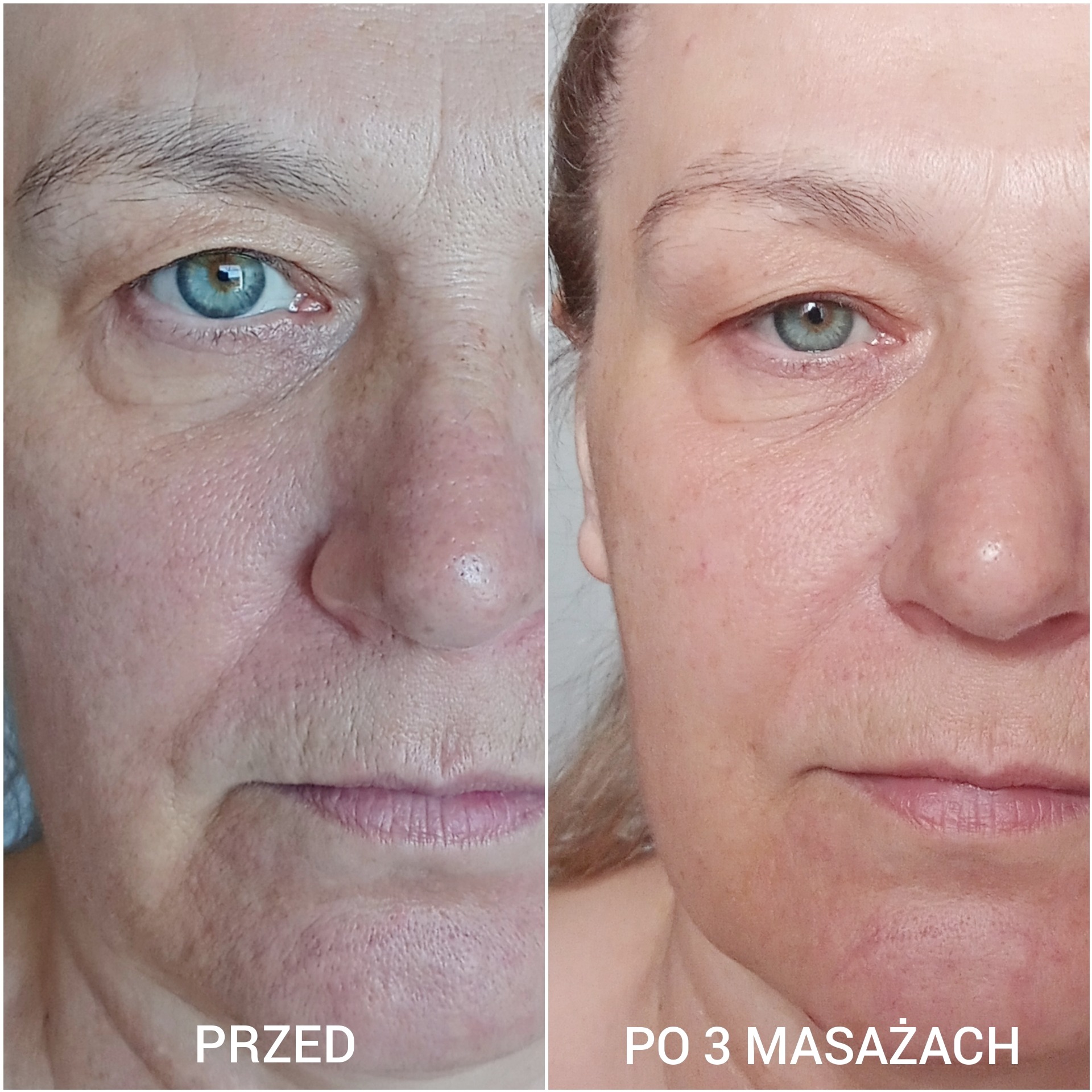 Porównanie stanu skóry twarzy przed i po serii trzech masaży, widoczne zmniejszenie zmarszczek i poprawa kolorytu skóry.