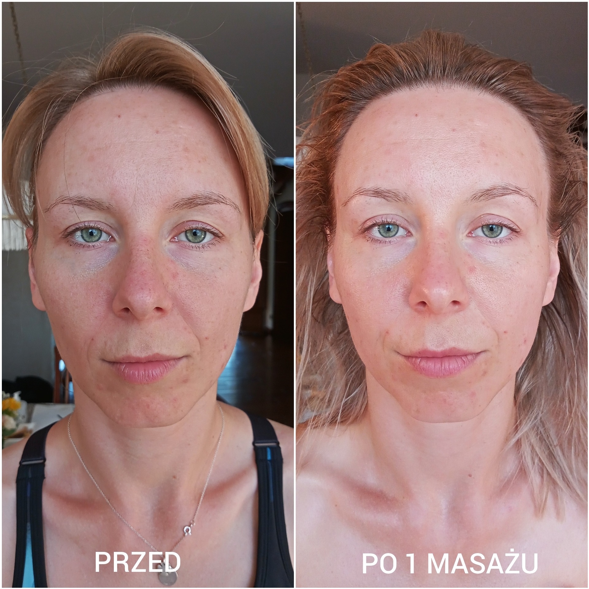 Zdjęcie typu 'przed i po' prezentujące twarz kobiety przed i po jednym masażu Kobido, z widoczną poprawą kolorytu i redukcją zaczerwienień.
