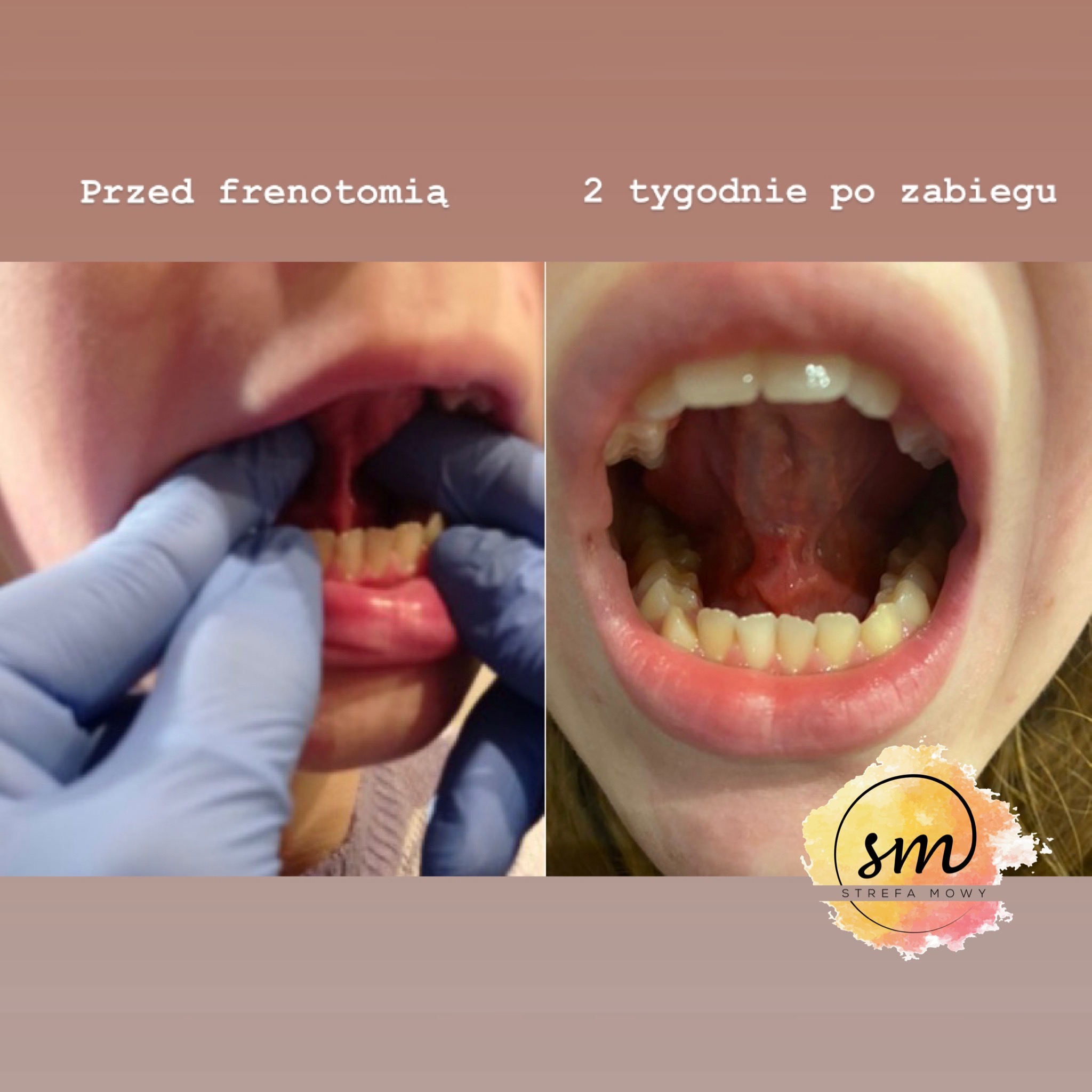 Zdjęcie porównawcze: widok wnętrza jamy ustnej przed i 2 tygodnie po zabiegu frenotomii, z widocznym wędzidełkiem języka i zębami.