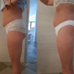 Zdjęcie przedstawia porównanie sylwetki kobiety przed i po zabiegu, widoczne z profilu, w bieliźnie, na tle jasnej ściany i podłogi w kratkę.