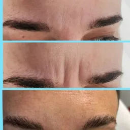 Trzy zbliżenia na czoło i brwi kobiety, prezentujące zmiany w zmarszczkach mimicznych przed i po zabiegu, z widoczną poprawą jędrności skóry.