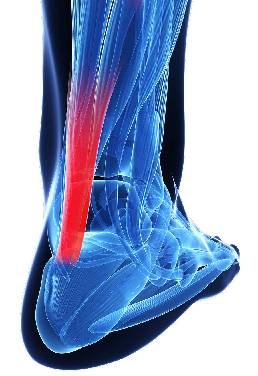 Masaż i rehabilitacja ścięgna Achillesa