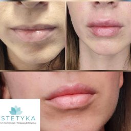 ESTETYKA Centrum Kosmetologii i Medycyny Estetycznej - Zbliżenie na usta kobiety przed i po zabiegu powiększania, widoczne lekkie zaczerwienienie i obrzęk po zabiegu, w dolnej części logo salonu kosmetycznego.