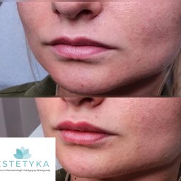 ESTETYKA Centrum Kosmetologii i Medycyny Estetycznej - Zbliżenie na usta i dolną część twarzy kobiety, widoczne porównanie przed i po zabiegu powiększania ust, z delikatnym efektem wypełnienia i wygładzenia, w dolnej części logo gabinetu.