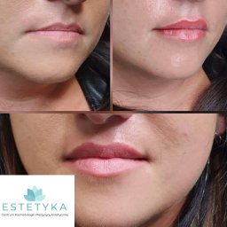 ESTETYKA Centrum Kosmetologii i Medycyny Estetycznej - Zbliżenie na usta kobiety przed i po zabiegu, z widocznym efektem powiększenia i podkreślenia konturu, prezentowane w formie kolażu.