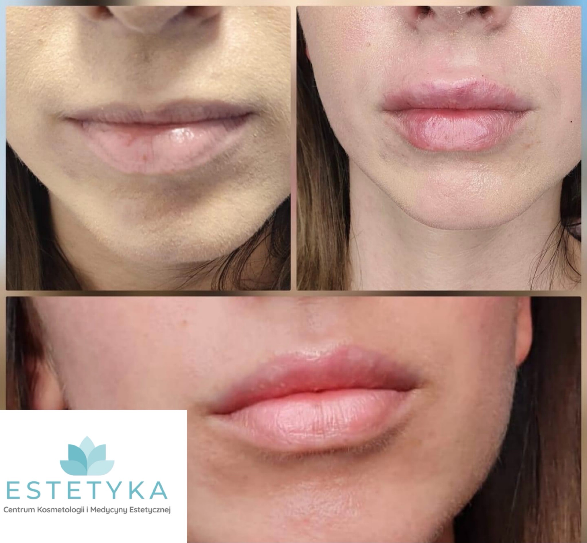 Zbliżenie na usta kobiety przed i po zabiegu powiększania, widoczne lekkie zaczerwienienie i obrzęk po zabiegu, w dolnej części logo salonu kosmetycznego.