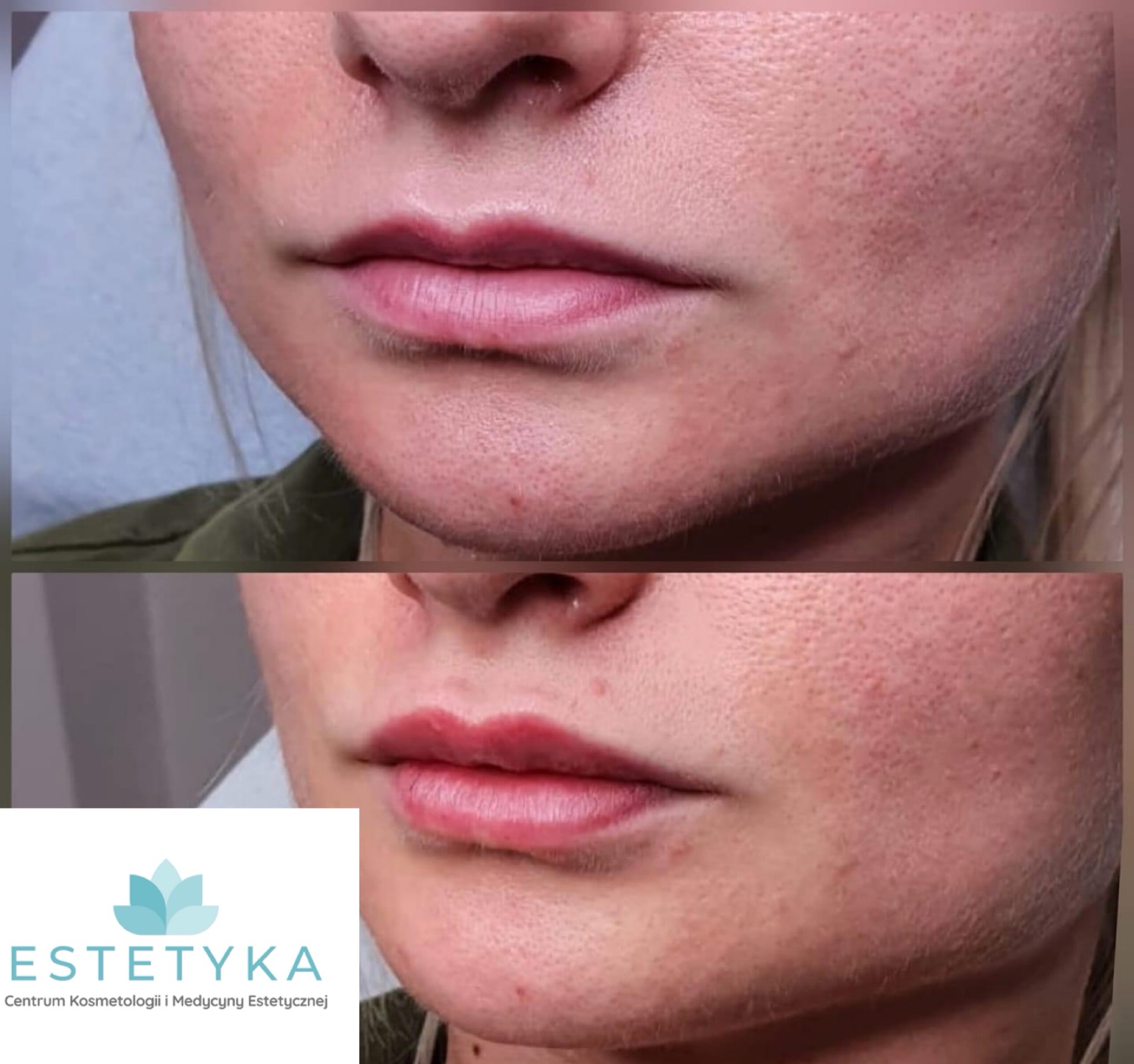 Zbliżenie na usta i dolną część twarzy kobiety, widoczne porównanie przed i po zabiegu powiększania ust, z delikatnym efektem wypełnienia i wygładzenia, w dolnej części logo gabinetu.