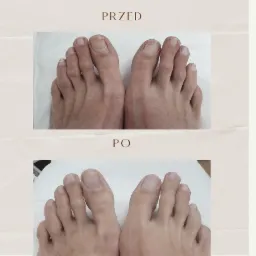Zdjęcie stóp przed i po zabiegu pedicure, ukazujące poprawę wyglądu paznokci i skóry, z widocznym efektem nawilżenia i wygładzenia.