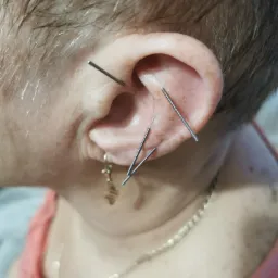 Acupuncture needles inserted into a patient's ear, close-up view showing the needles and the ear's anatomy, with a gold chain and earring visible.