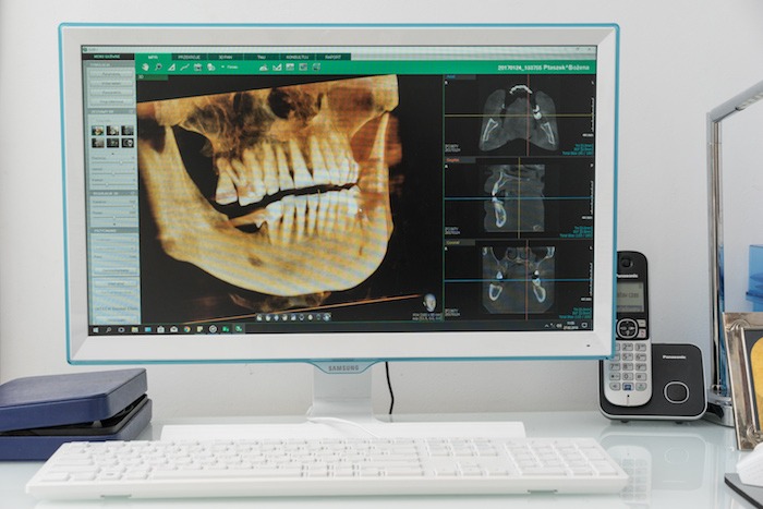 Ekran komputera prezentuje trójwymiarowy rentgenowski obraz szczęki pacjenta w gabinecie lekarskim.