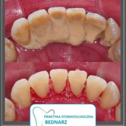 Porównanie zębów przed i po zabiegu higienizacji: górny rząd z widocznym kamieniem nazębnym, dolny rząd po usunięciu osadu i kamienia, z widocznym logo gabinetu stomatologicznego w rogu.