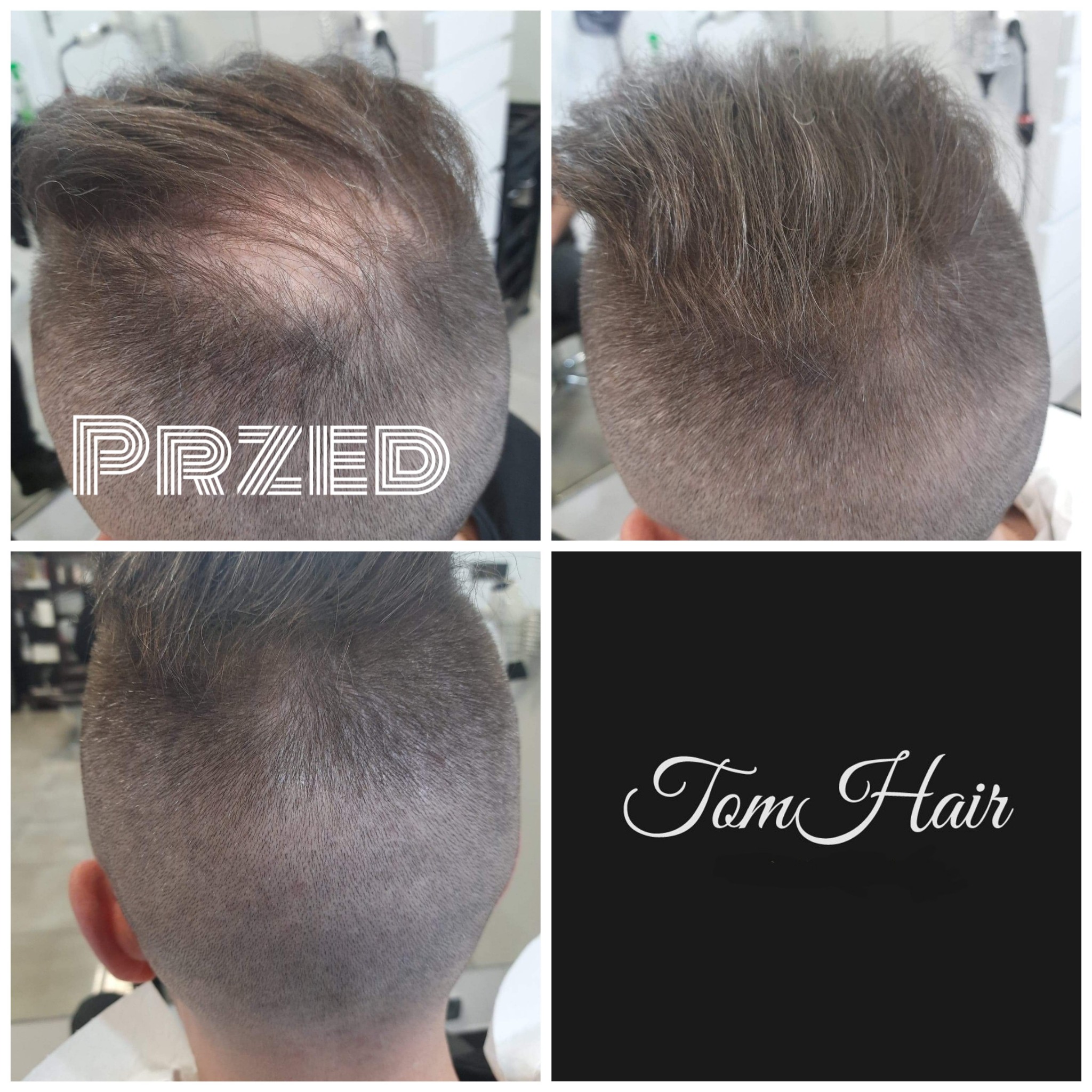 Czteropanelowe zdjęcie przedstawiające męską głowę przed i po zabiegu, z widocznym przerzedzeniem włosów na górze głowy w sekcji 'Przed' oraz logo 'Tom Hair' w czwartym panelu.