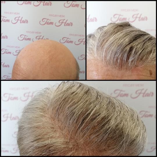 Męska głowa przed i po zabiegu uzupełniania włosów, widoczne różnice w gęstości i wyglądzie fryzury na tle ściany z logo salonu.