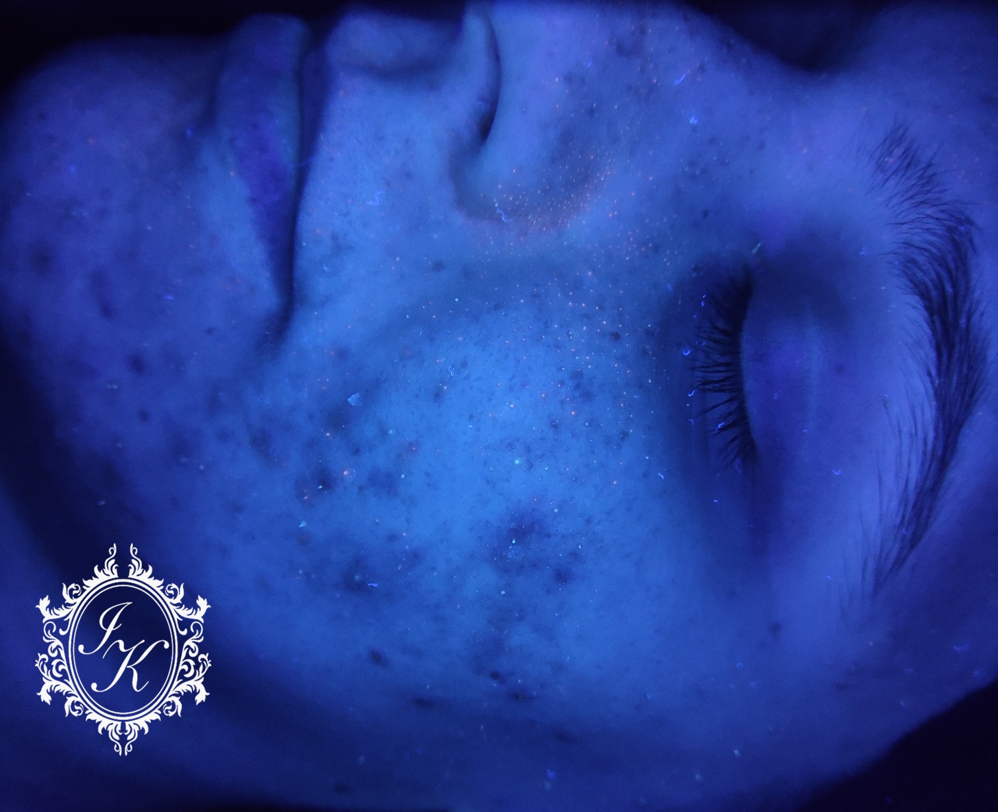 Tak wygląda Wasza skóra podczas badania Lampą Wood'a :D