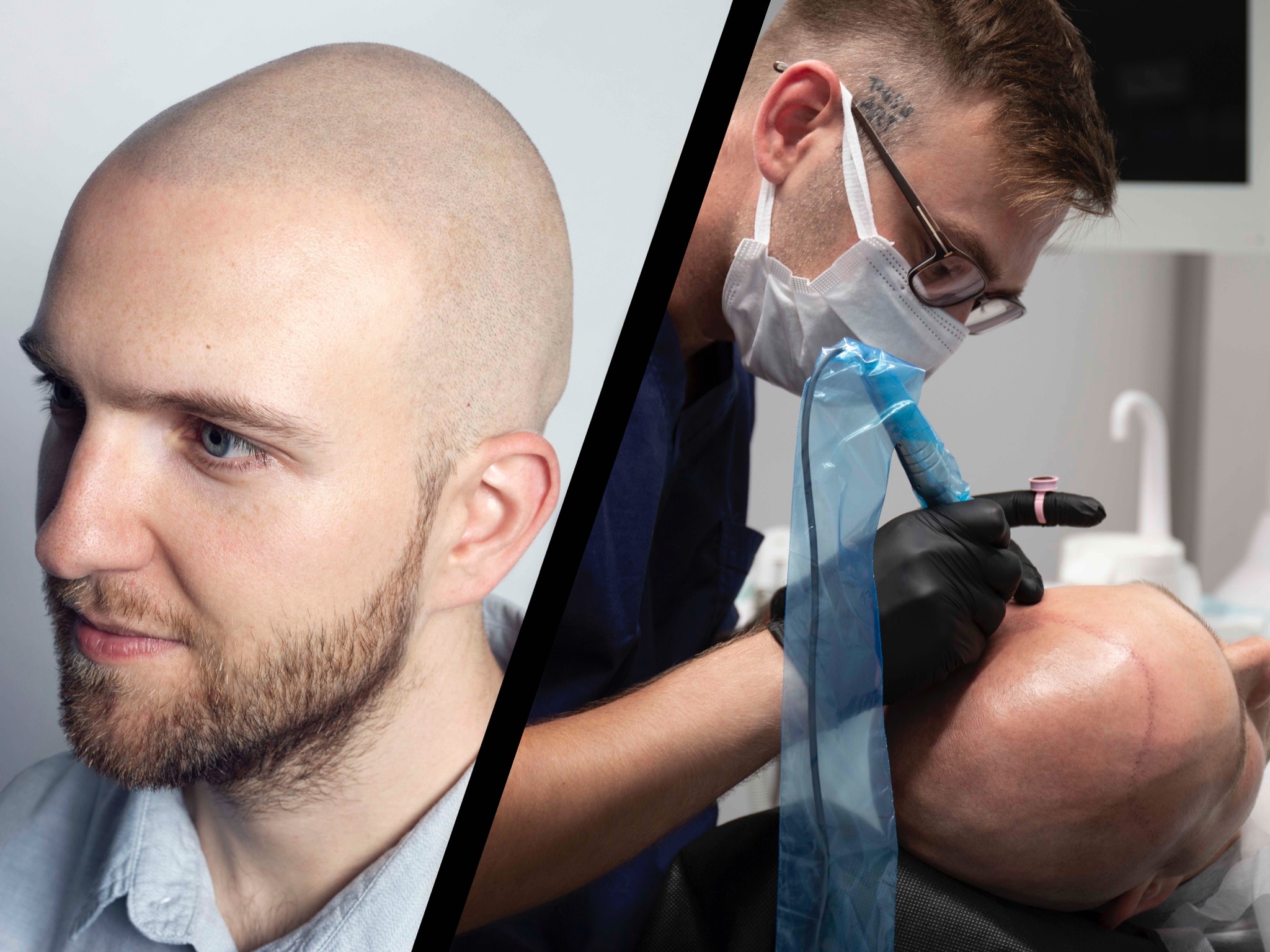 Mikropigmentacja skóry głowy: zbliżenie na proces aplikacji pigmentu na skórze głowy pacjenta przez specjalistę w rękawiczkach, widoczny sprzęt i przygotowana skóra głowy, po lewej stronie...