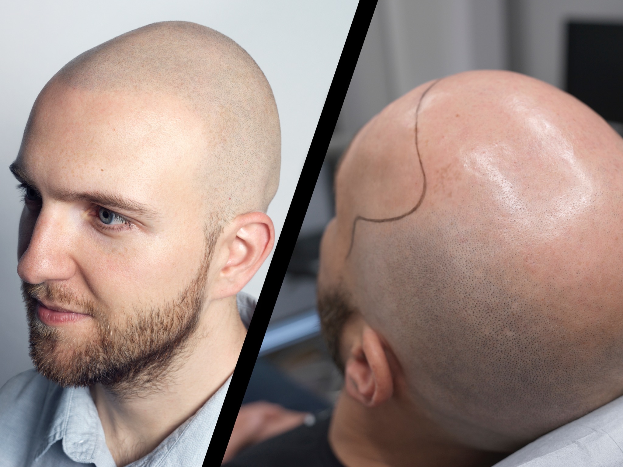 Mikropigmentacja skóry głowy Poznań