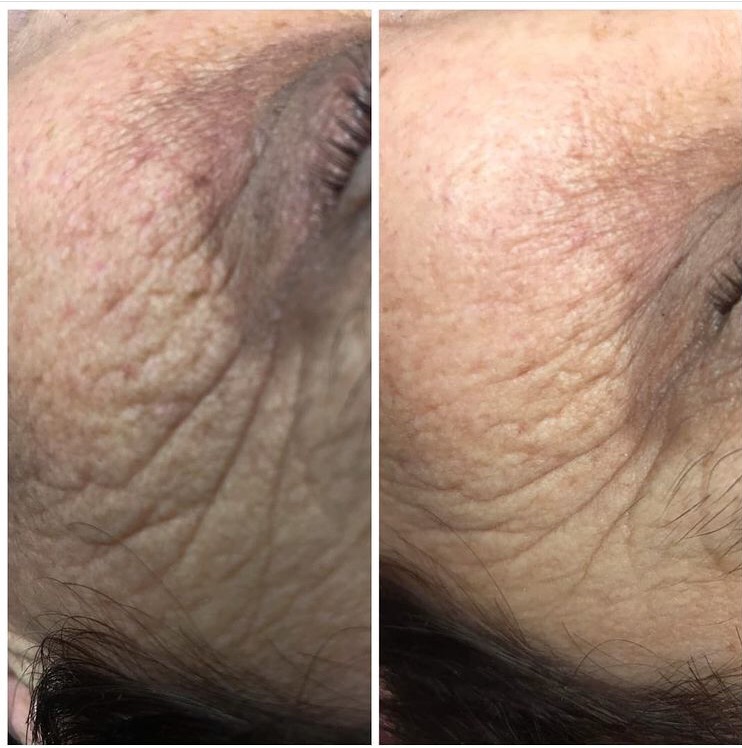 Efekt bezpośrednio po zabiegu EyeTox Peel