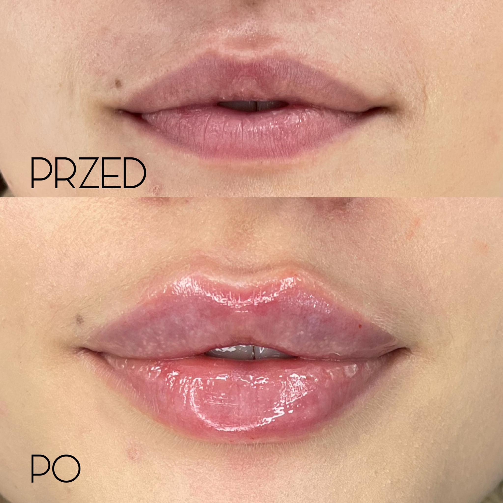 Zbliżenie na usta kobiety przed i po zabiegu powiększania, widoczne różnice w objętości i nawilżeniu, z wyraźnym efektem błyszczących ust po zabiegu.