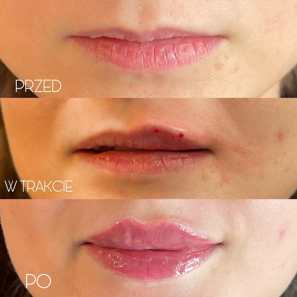 Usta kobiety w trzech etapach: przed zabiegiem, w trakcie z widocznymi śladami iniekcji oraz po zabiegu z efektem powiększenia i nawilżenia, widoczne delikatne zaczerwienienie.