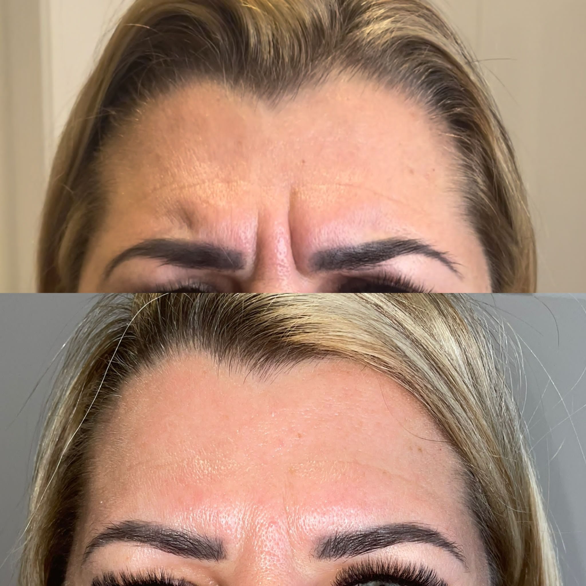 Porównanie stanu skóry na czole przed i po zabiegu redukcji zmarszczek mimicznych, widoczne wygładzenie skóry.