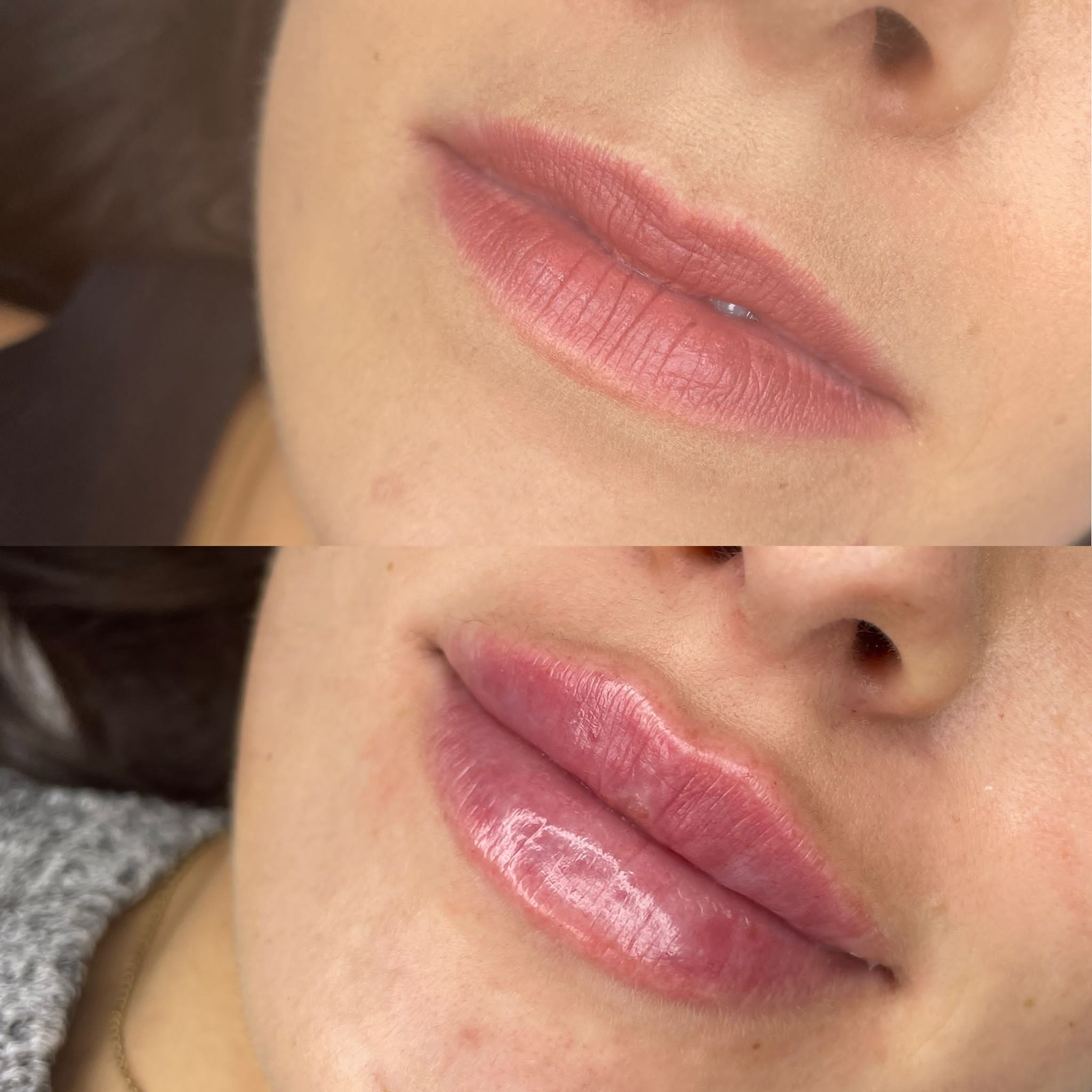 Ujęcie zbliżeniowe ust kobiety przed i po zabiegu powiększania, widoczne różnice w objętości i nawilżeniu.